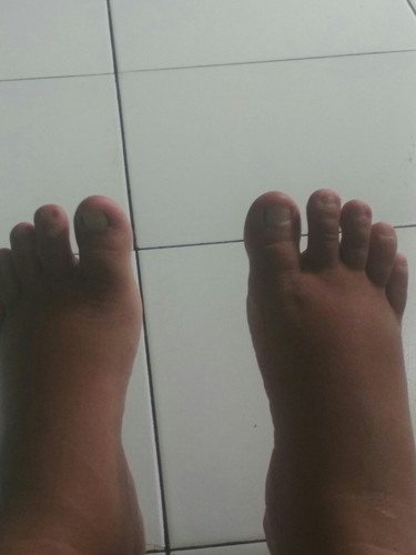kaki bengkak
