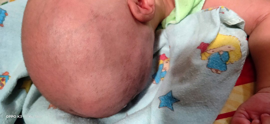 benjolan kepala bayi