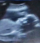 CLIFT LIP AND PALATE