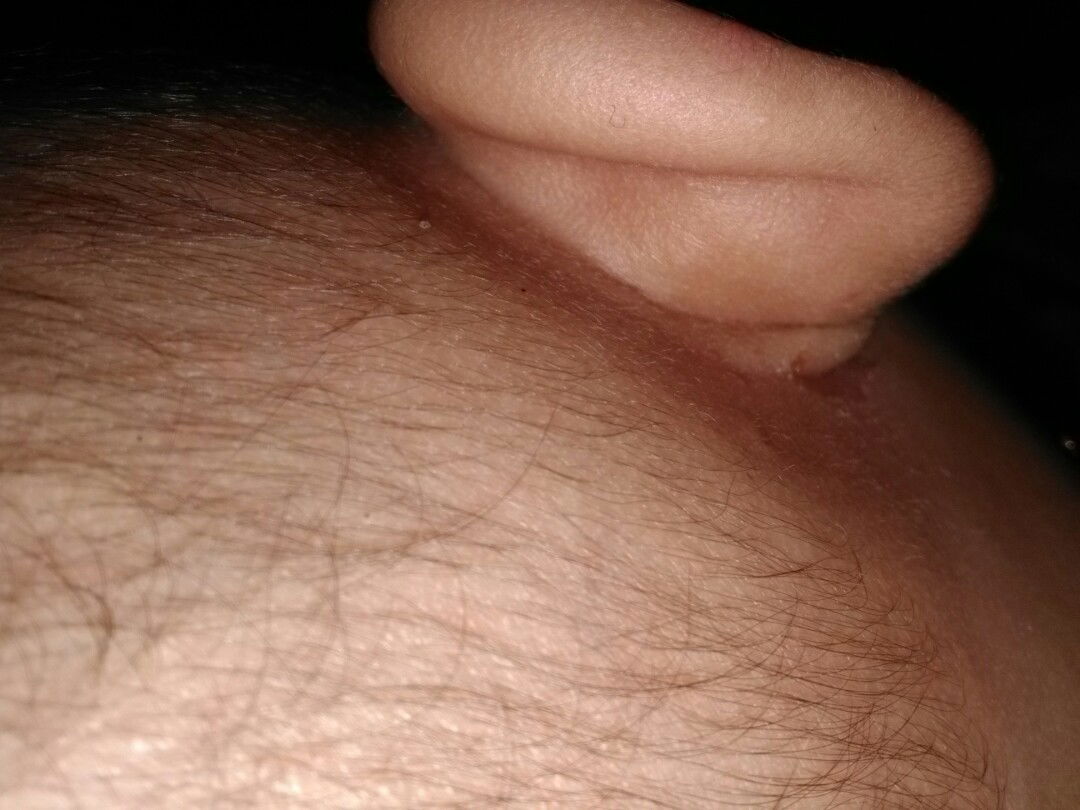 Luka dilipatan telinga