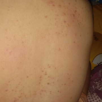 สิวบุกหลัง