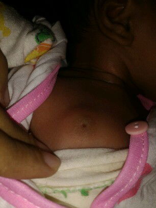 payudara bayi bengkak