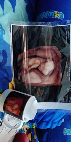 usg babynya berdiri