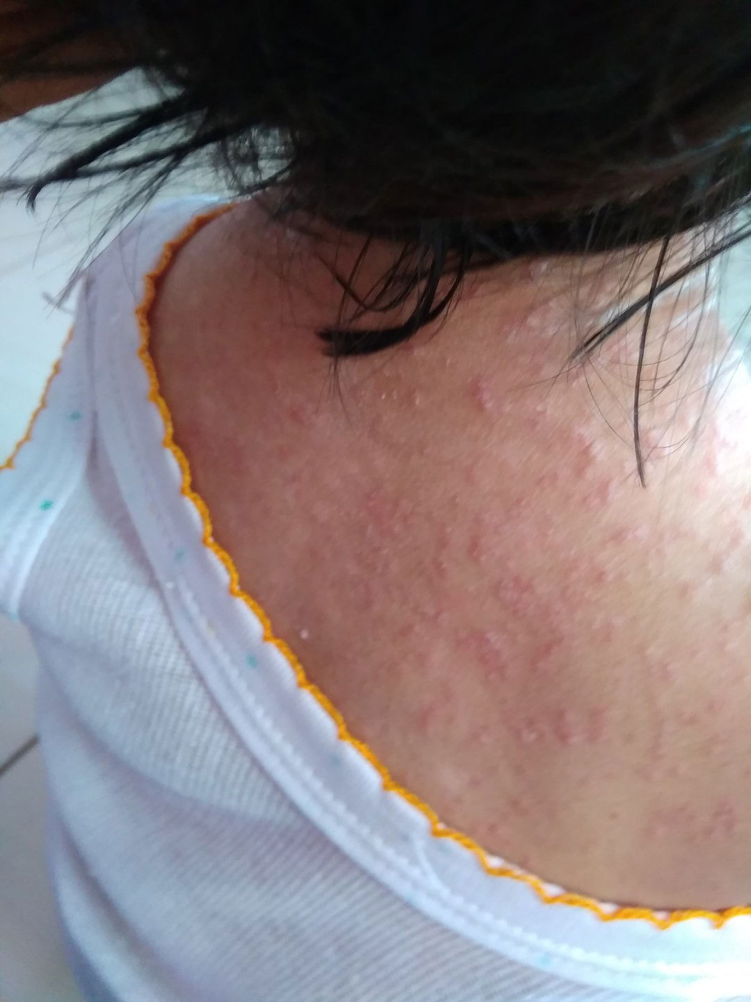 gmn solusinya gatal2 anak...