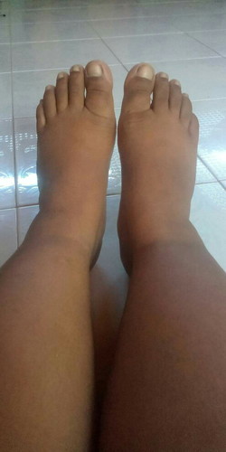 อาการมือเท้าบวม