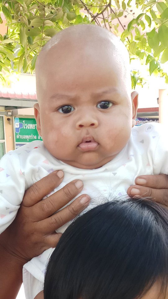 รอยด่างที่เกิดหลังกลากน้ำนมหาย