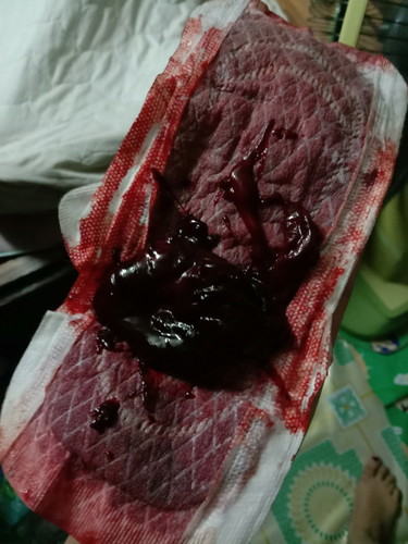 ตกเลือด/ท้องลม