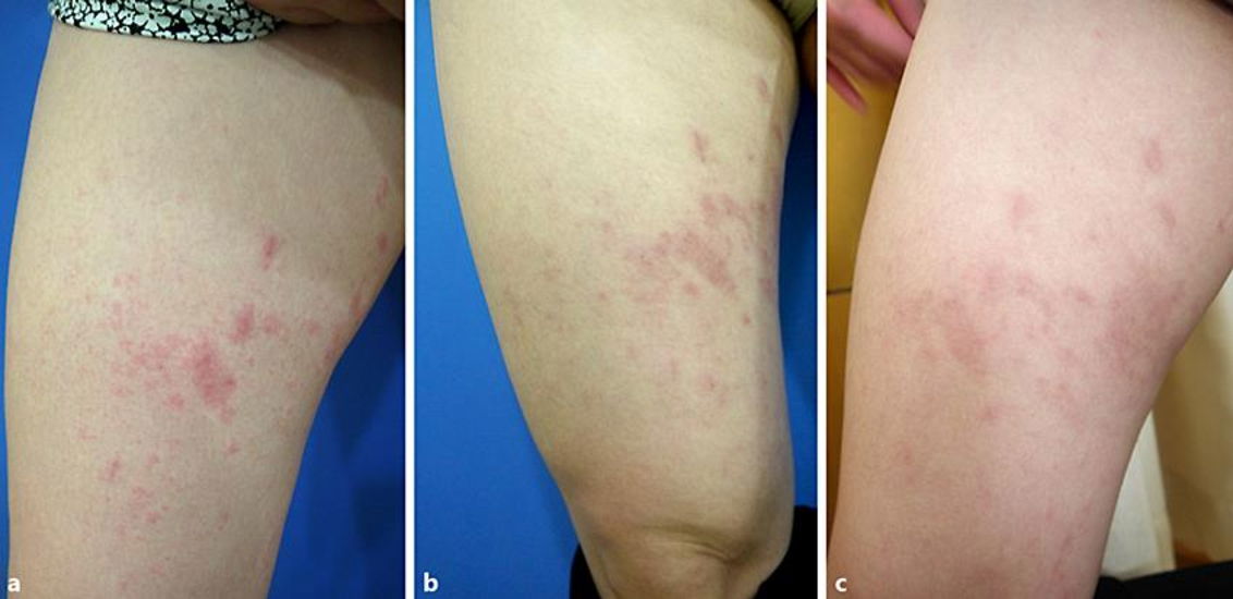 Pruritic Urticarial Papules and Plaques of Pregnancy (PUPPP) !!