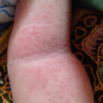 bintik2 merah dan berair