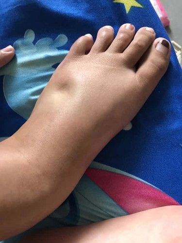 ความดันสูง+เท้าบวมอันตรายกว่าที่คิด