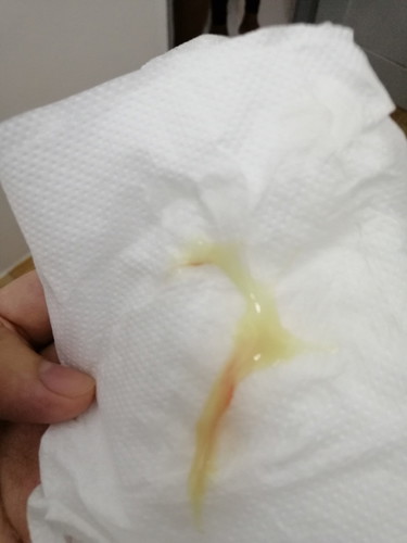 Mucus Plug?