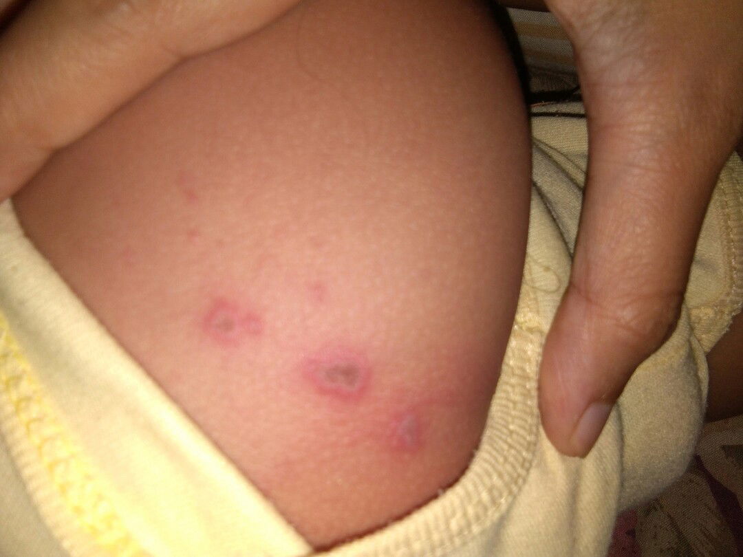 di paha anak ada semacam bentol²