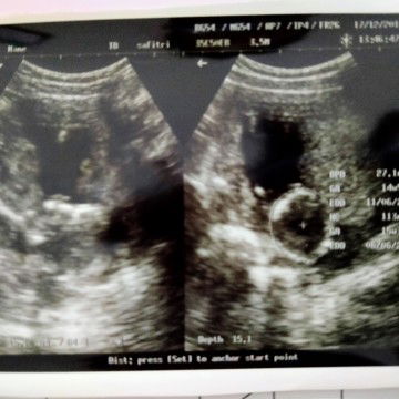 Kecelakaan saat usia kandungan 13 week ?