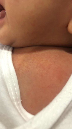 Rashes?