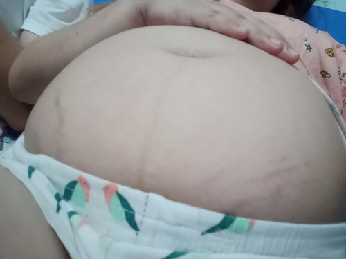 Stretch mark