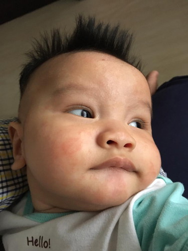 Baby saya naik ruam dekat muka. Takut ekzema dan saya tak ada pengalaman, anak first.