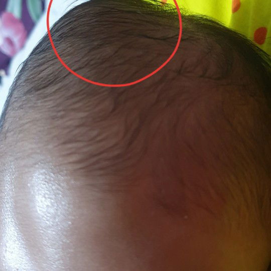 Benjolan di kepala bayi