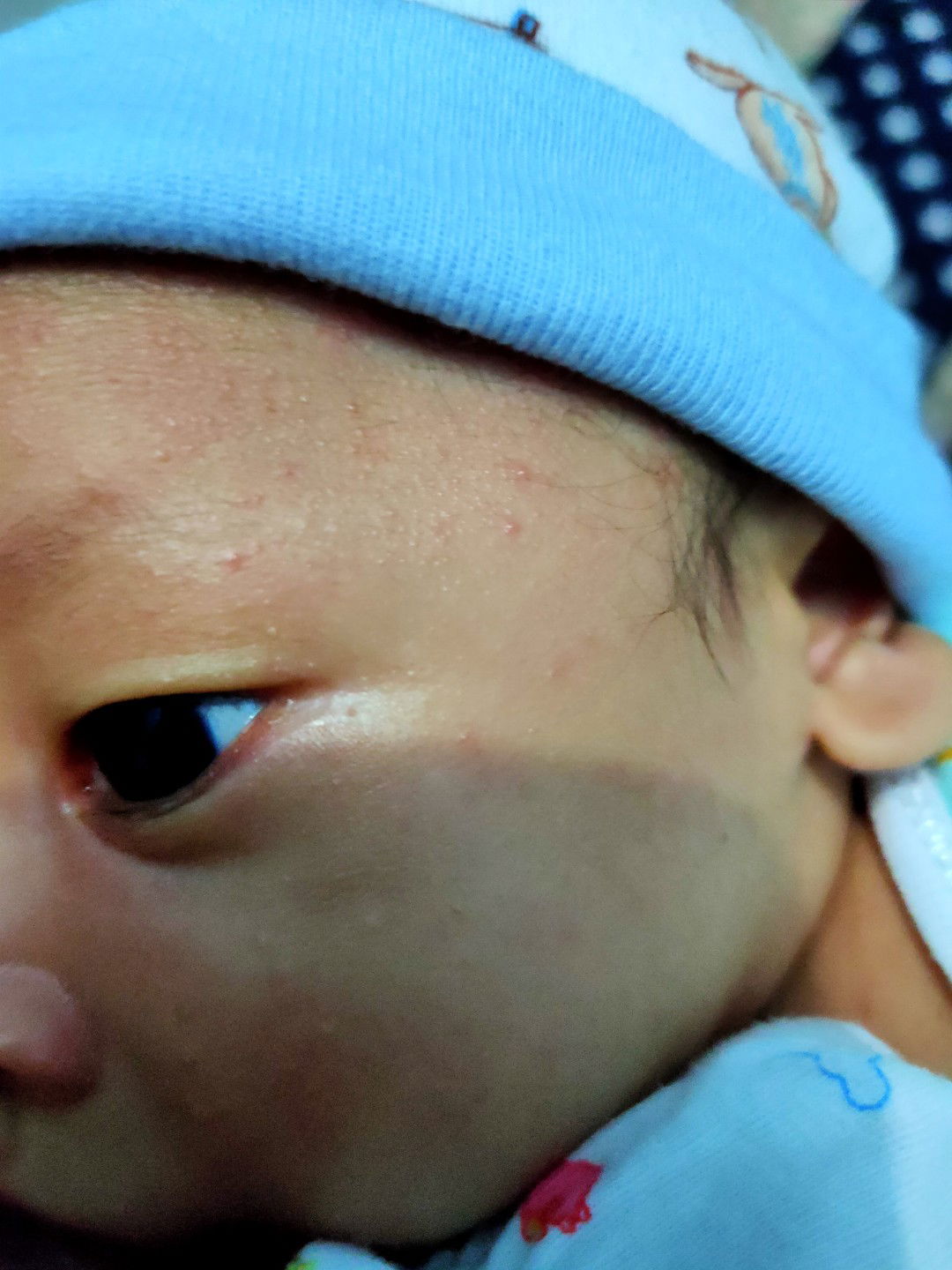 kulit bayi 1 bulan memerah