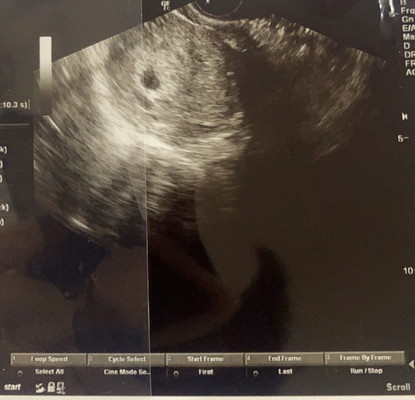 คุณแม่ U/S เจอเบบี๋กันตอนท้องกี่ Week คะ