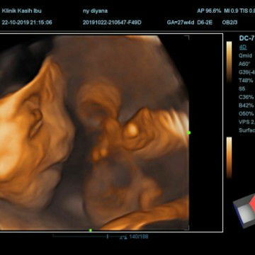 uk 33 week, perut sering kencang,nyeri pinggang,susah tidur....adakah yg sama???