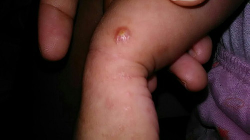 bentol"tengahnya ada titik kuning