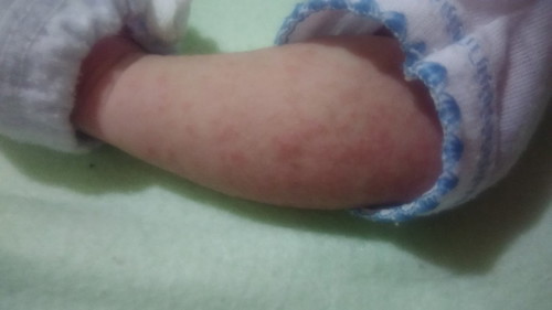 rashes