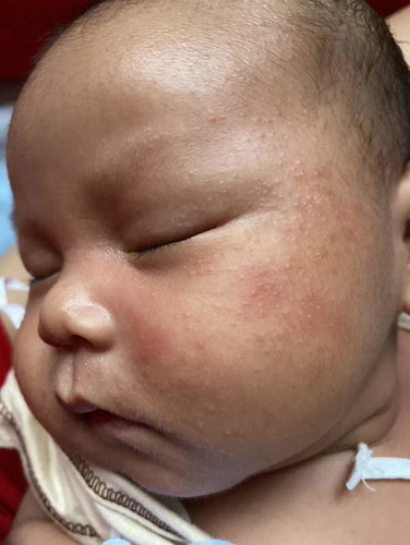 ผดผื่นที่ใบหน้าลูก