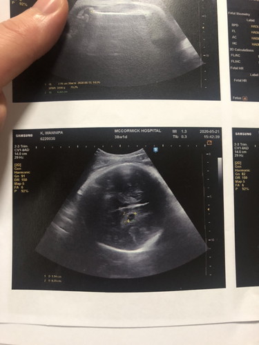 เจอถุงน้ำในสมองลูก