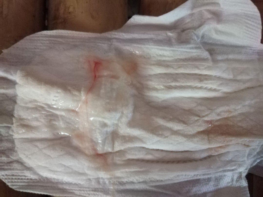 มีมูกเลือดแบบนี้ไปโรงบาลไหมคะ