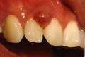 pregnancy gums enlargement