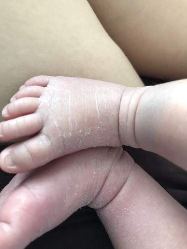 ลูกผิวลอก