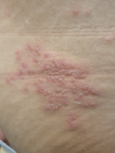 shingles while pregnant