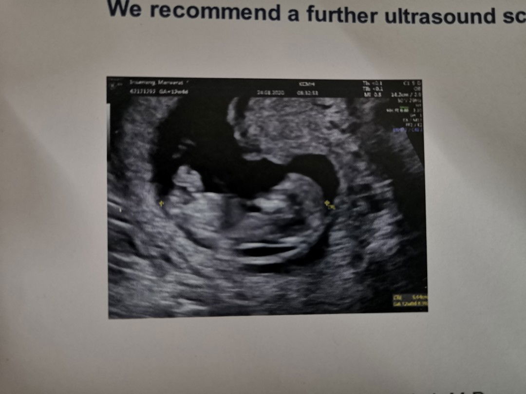 อัพเดทอาการเเท้งคุกคาม​สัปดาห์​ที่12