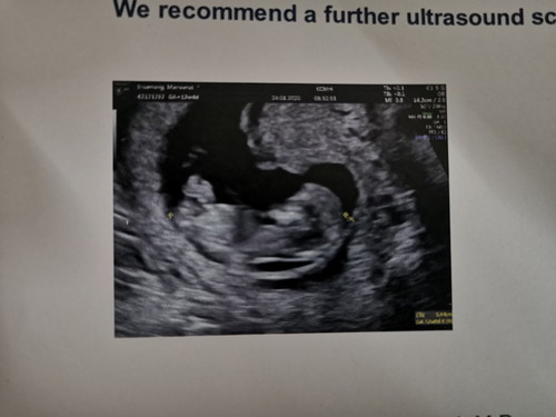 อัพเดทอาการเเท้งคุกคามสัปดาห์ที่12