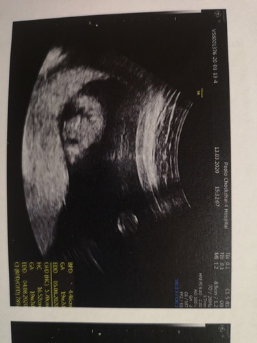 22สัปดาห์5วันหายจากเเท้งคุกคามเเล้ว