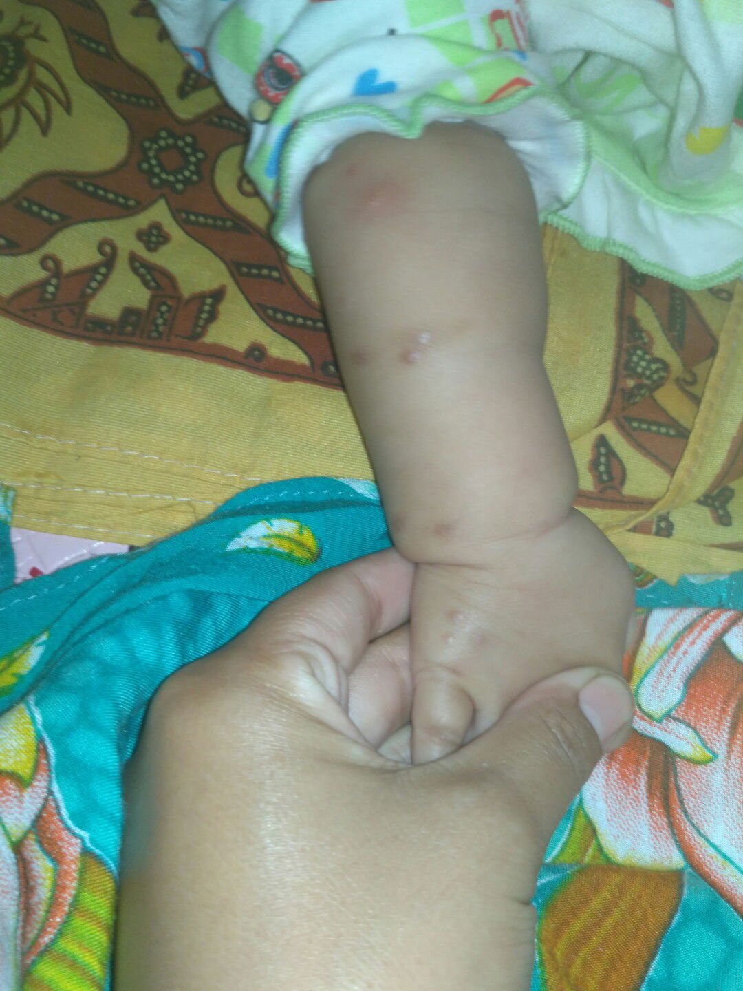 noda hitam bekas gigitan nyamuk