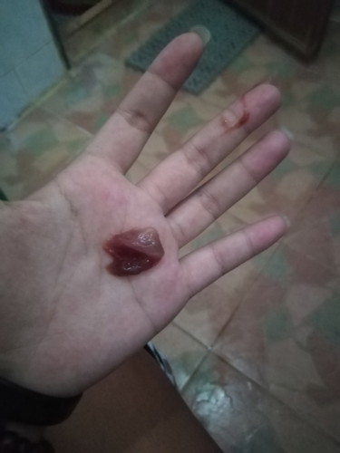 มีมูกแบบนี้ไหลเป็นอะไรมั้ยคะ
