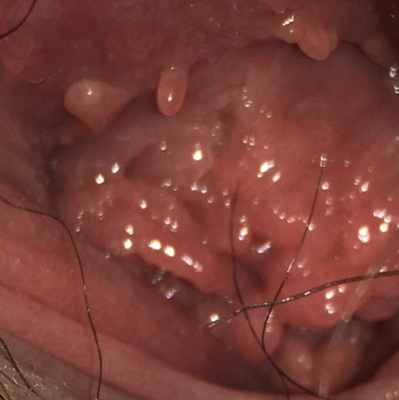 Genital warts.