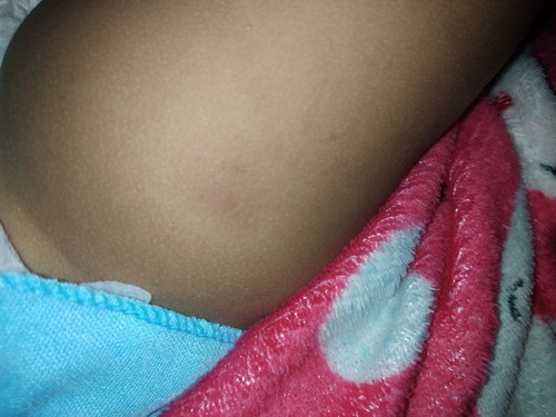 ฉีดวัคซีน6m ขาเป็นไตทำไงดี?