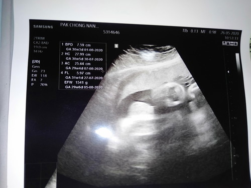 32+1 แต่น้องนน.น้อยไม่ตามเกณฑ์