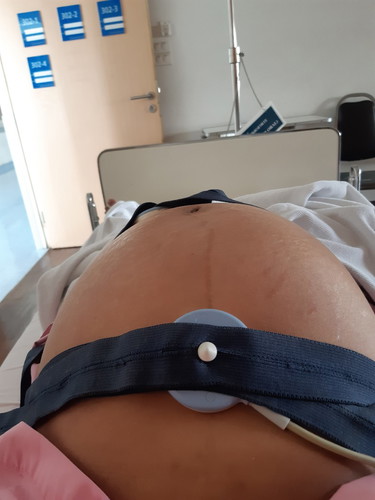 เตรียมรอแตกแล้วจ้าผ่าคลอด ✌🤰