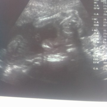 เพศลูก