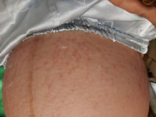 32 week แม่ๆคนไหนเป็นผื่นที่ท้องแบบนี้บ้างคะ