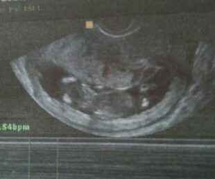 hi po .. makikita na po ba gender ni baby from this ultrasound?