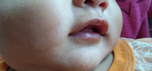 ผื่นรอบๆปาก