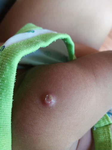 ปลูกฝี