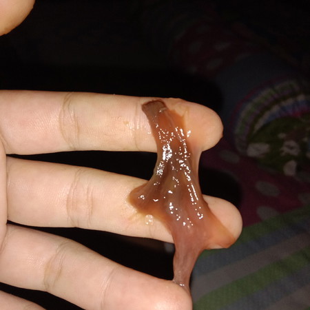 ถามแม่ๆคะ มูกเลือดแบบนี้ควรไป รพ.มั้ยคะ