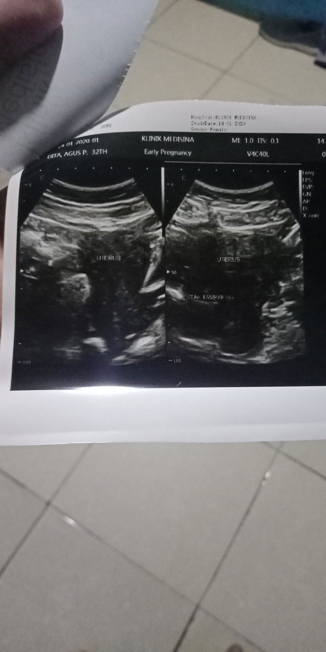 12w di usg tak nampak janin