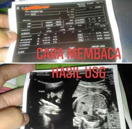 CARA MEMBACA HASIL USG KEHAMILAN