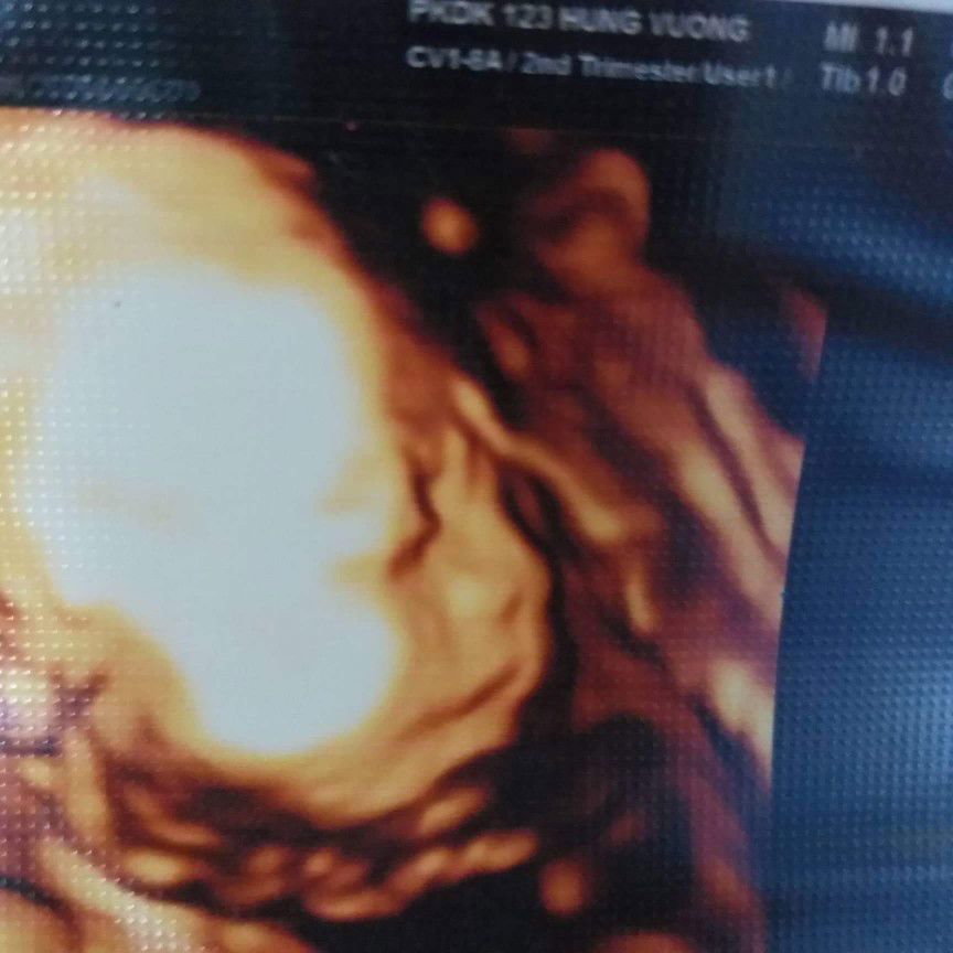 cac m cho e hoi, e 26w di kham bsy bao não bé giãn 7,1mm v có sao k? e di kham ve ma buon qua a